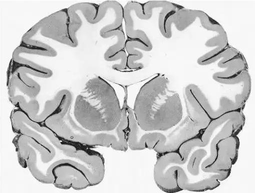 馬斯克腦機融合系統(tǒng)Neuralink
